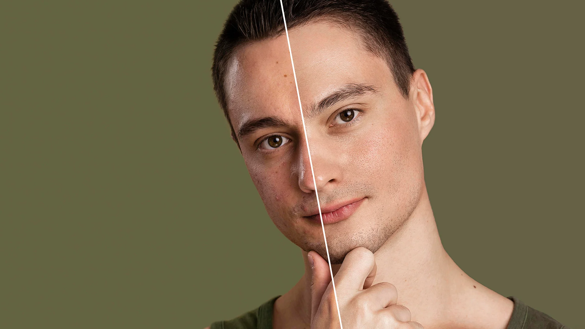 Acne Treatment 1 akne tedavisi