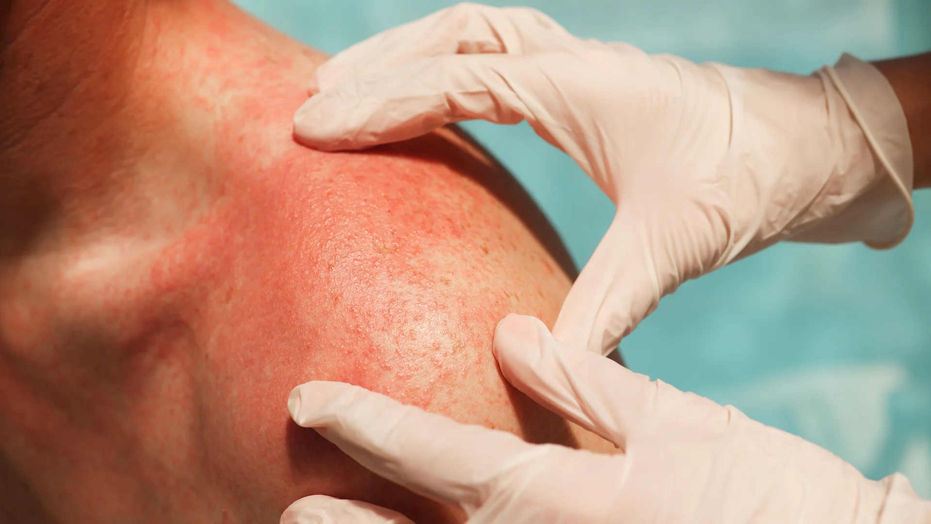 Allergic Skin Diseases 1 Allergic Skin Diseases