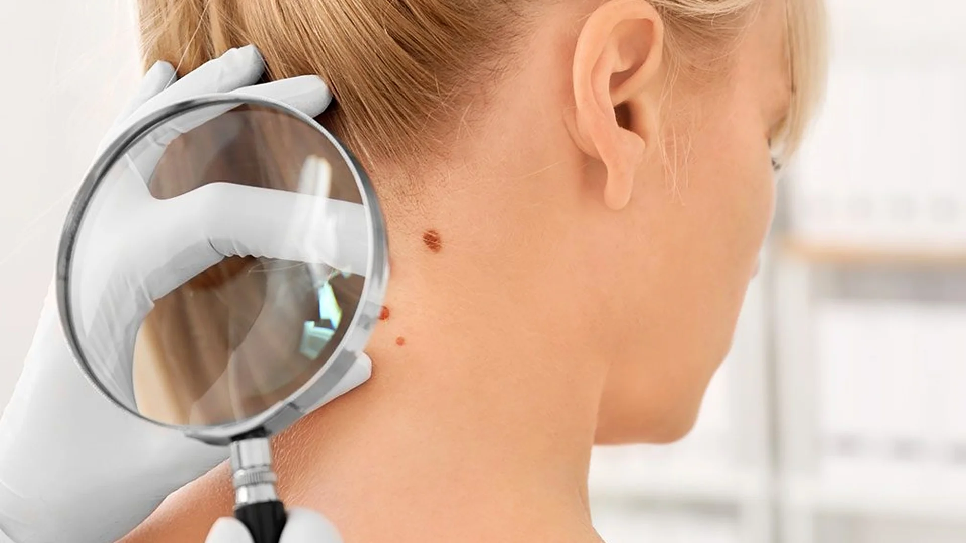 Mole Treatment 1 Mole Treatment