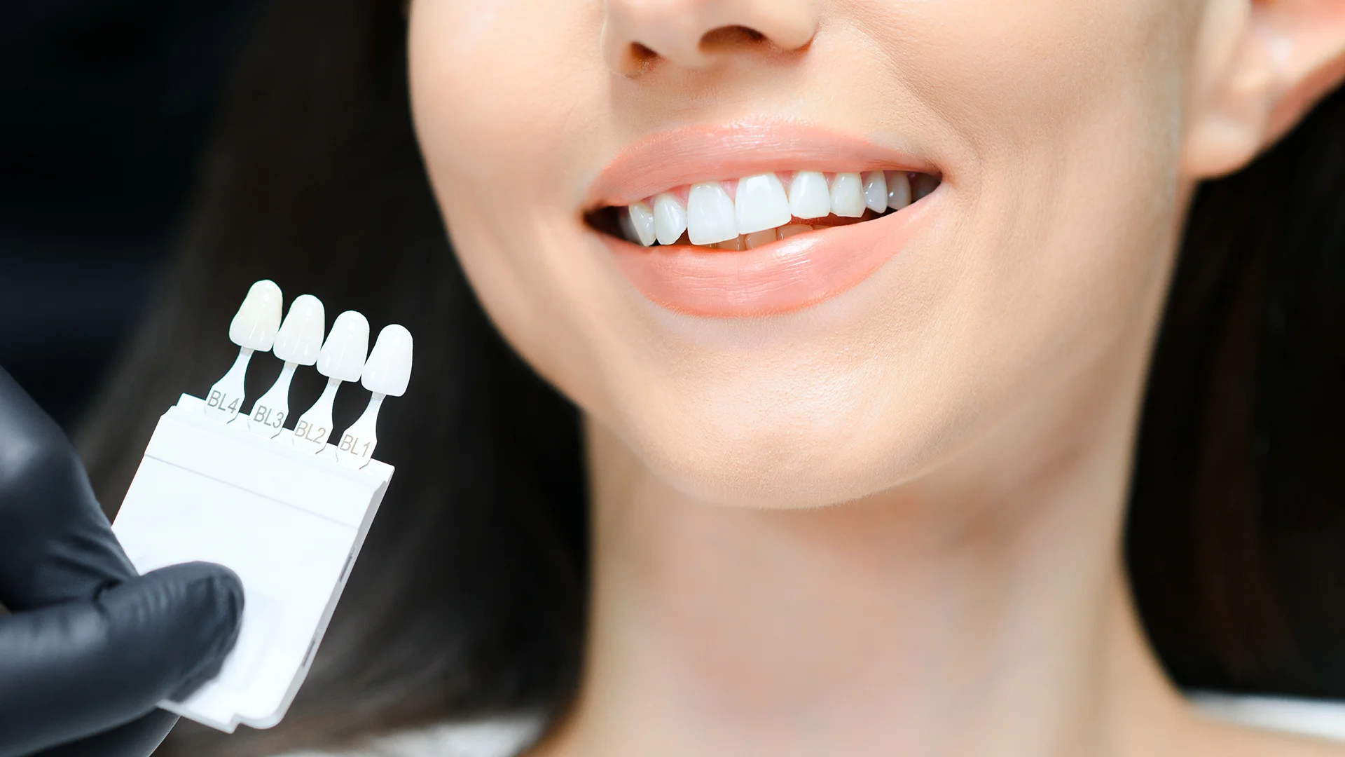 Carillas compuestas 1 Carillas compuestas