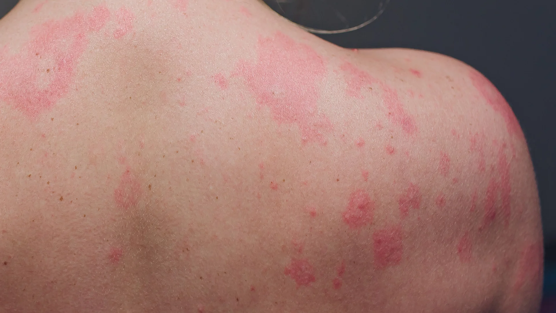 Rash Diseases 1 Rash Diseases