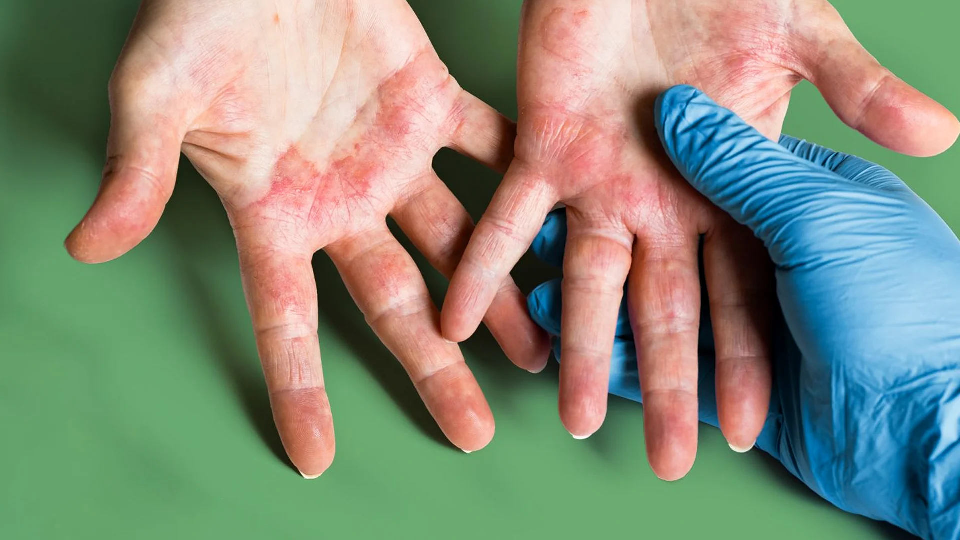 Eczema Treatment 1 egzama tedavisi