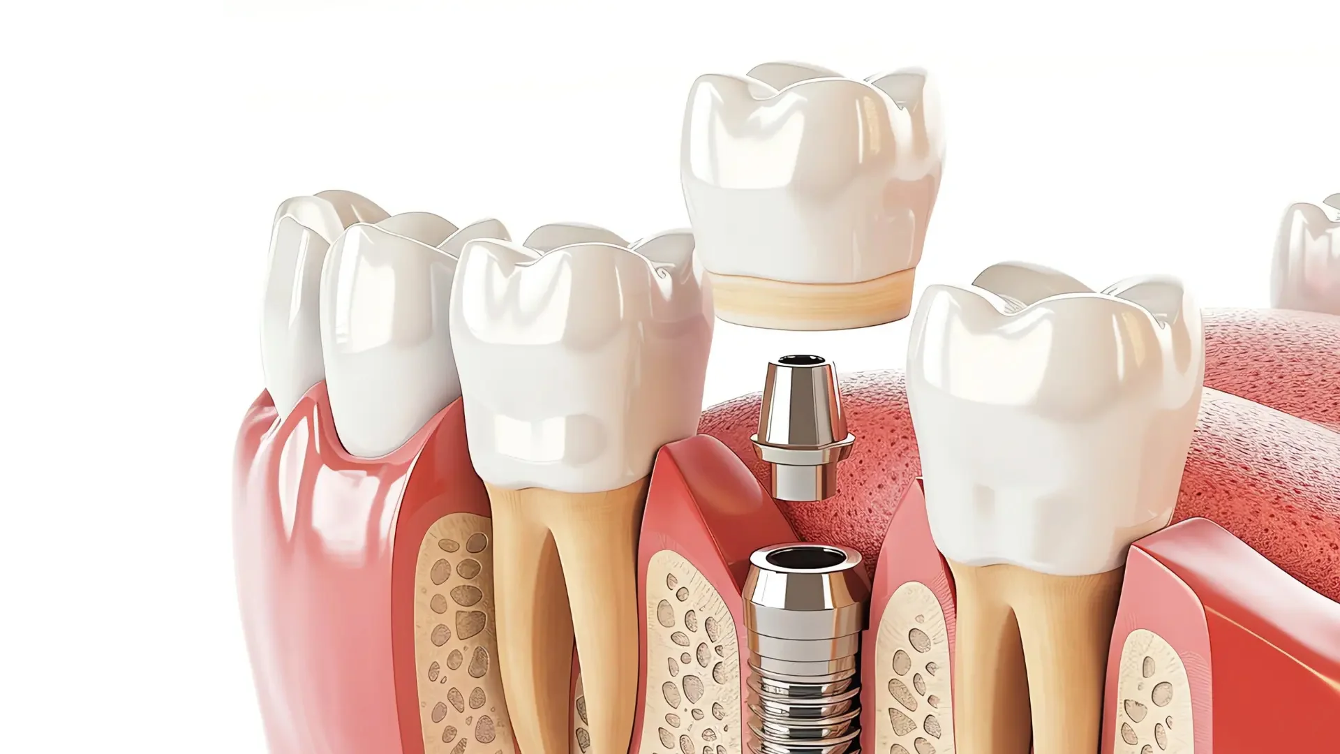 Implant endostéal 1 Endosteal İmplant