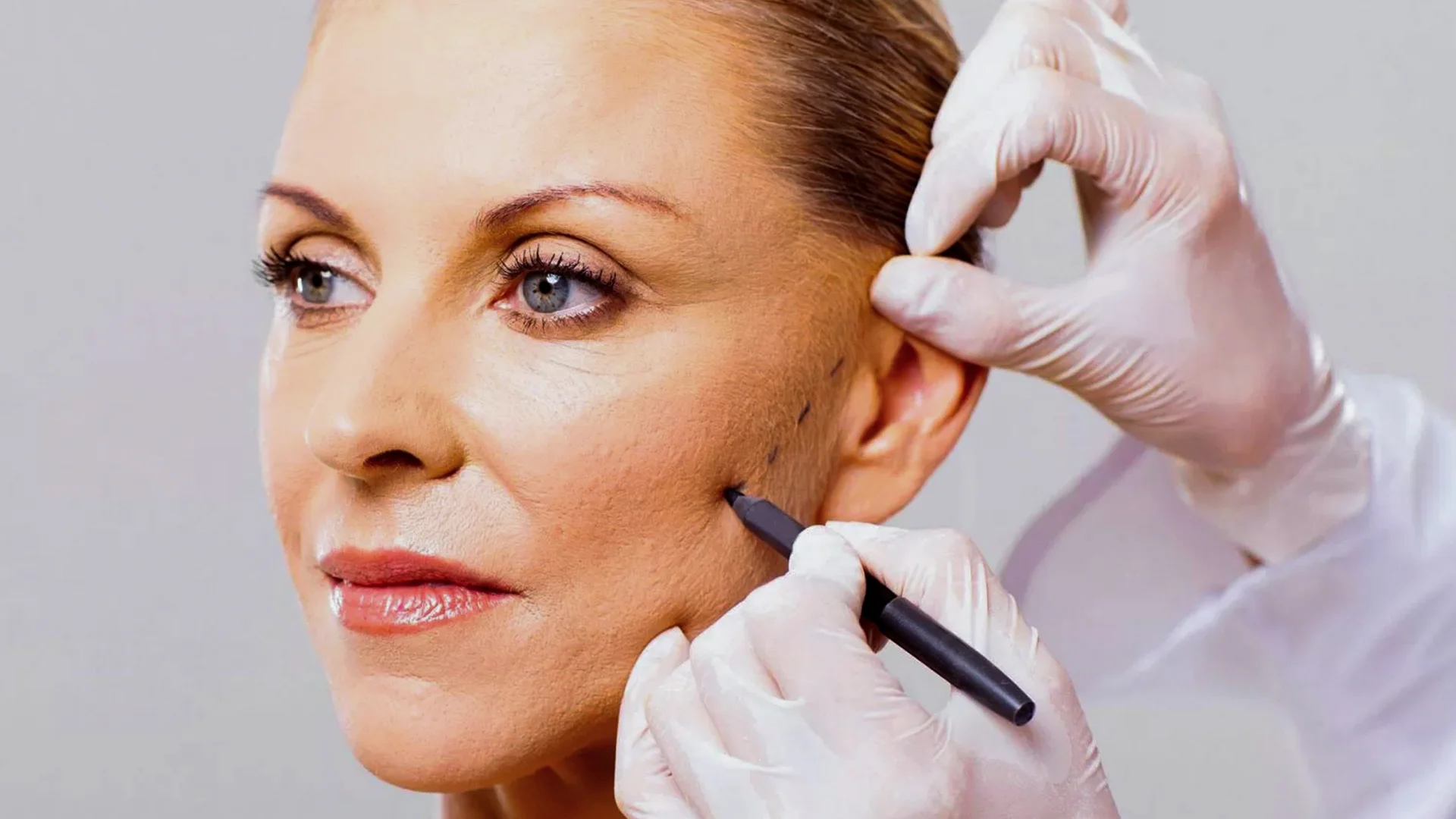 French Thread Lift 1 fransız askısı