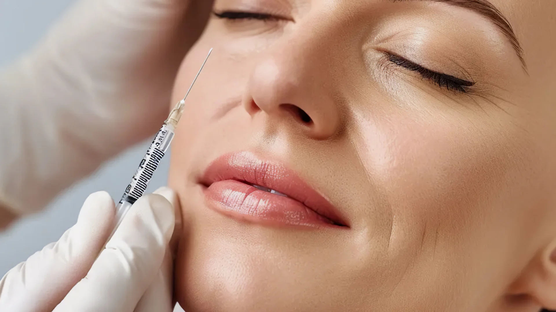 Nasolabial Marionette 1 Nasolabial Marionette