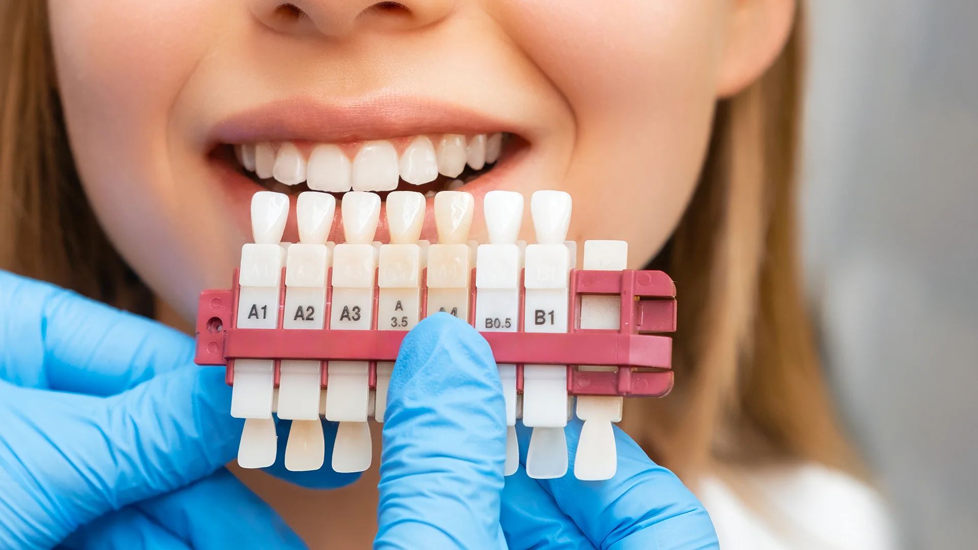 Carillas de porcelana 1 porcelain venerrs turkey