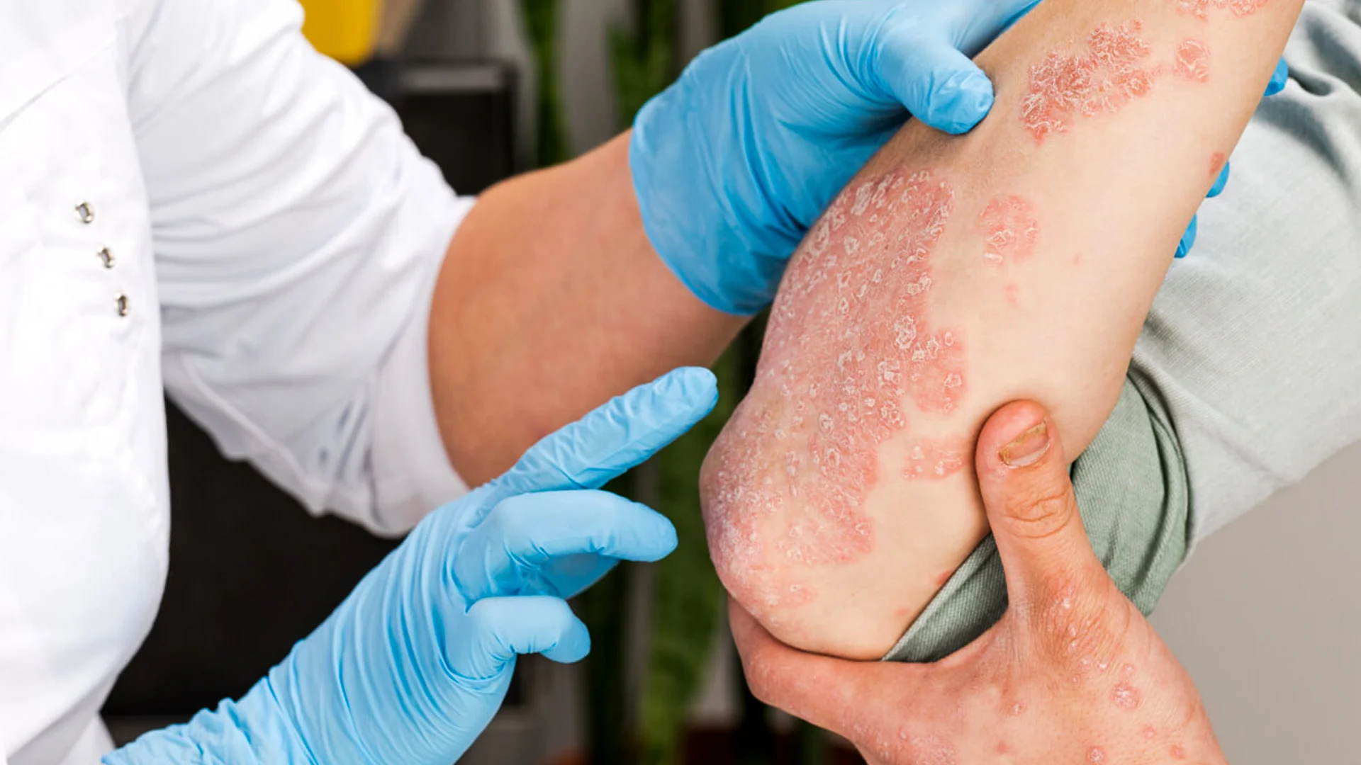 Psoriasis Treatment 1 sedef hastalığı tedavisi