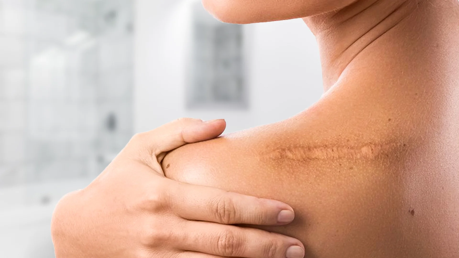 Scar (Wound Scar) Treatment