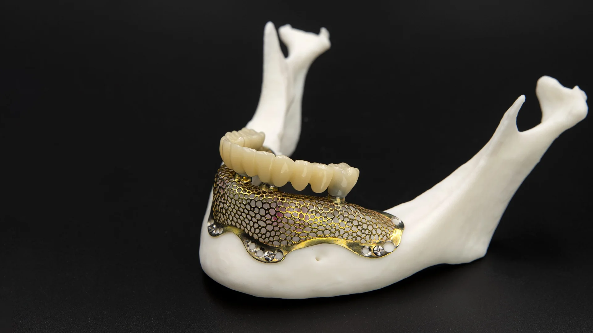 Implante subperipstésico 1 Subperipsteal İmplant