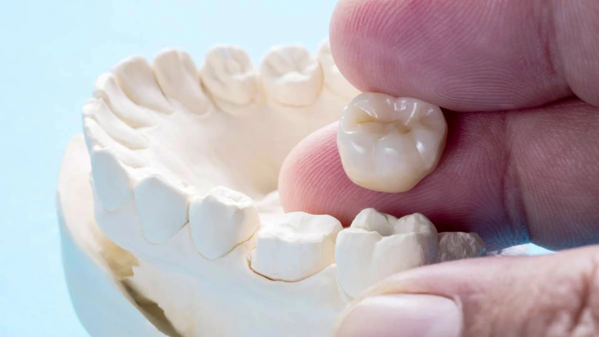 Geçici Kronlar 1 Geçici Kronlar