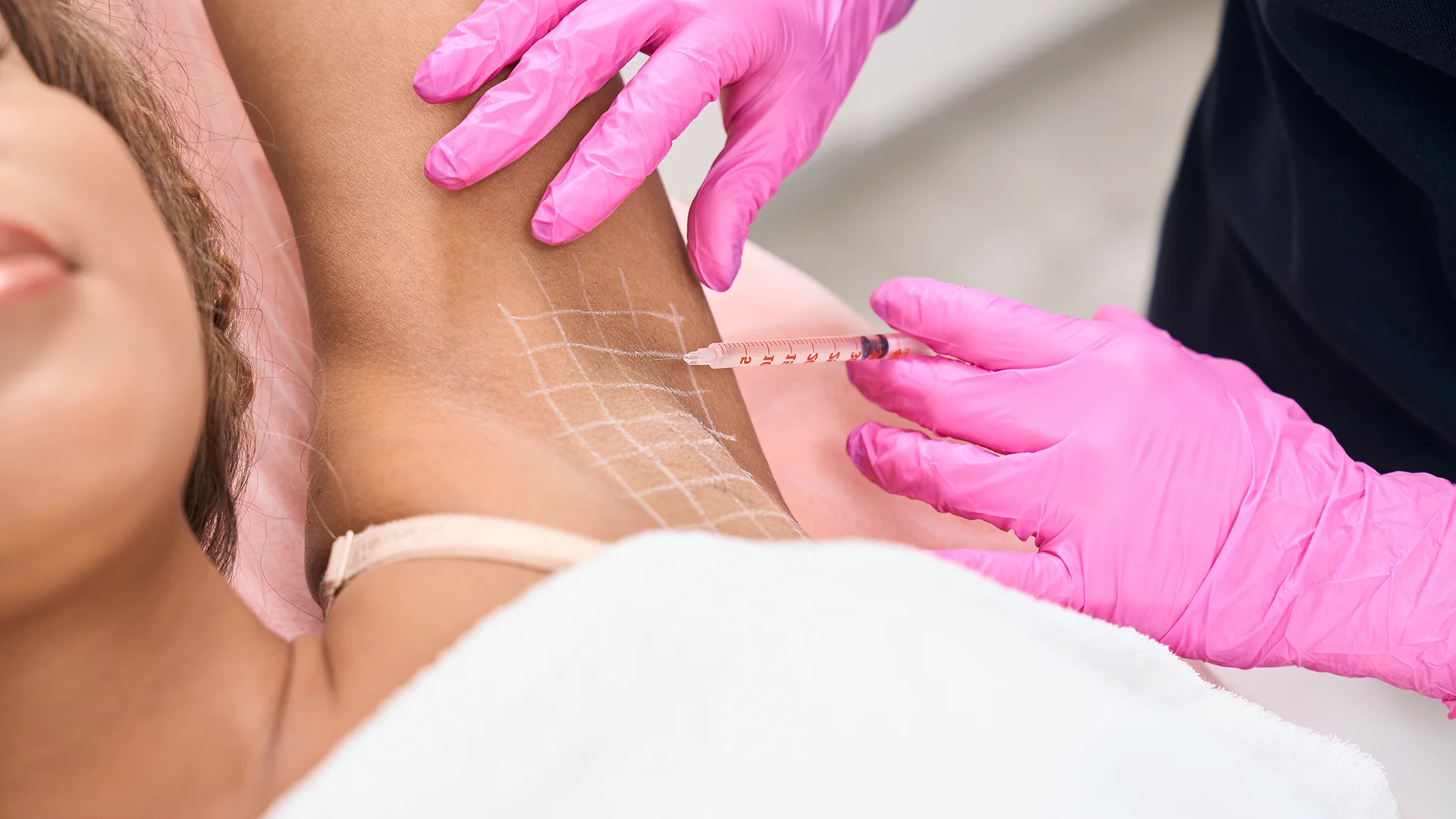 Sweat Botox 1 terleme botoksu