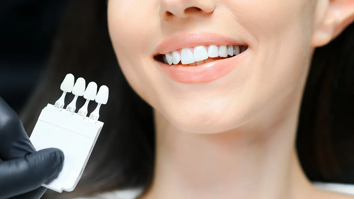 Facettes Composites 1 Facettes Composites