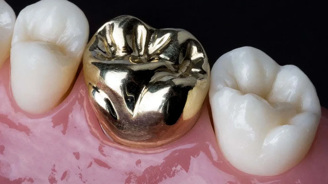 Gold Crowns 1 Gold Crowns