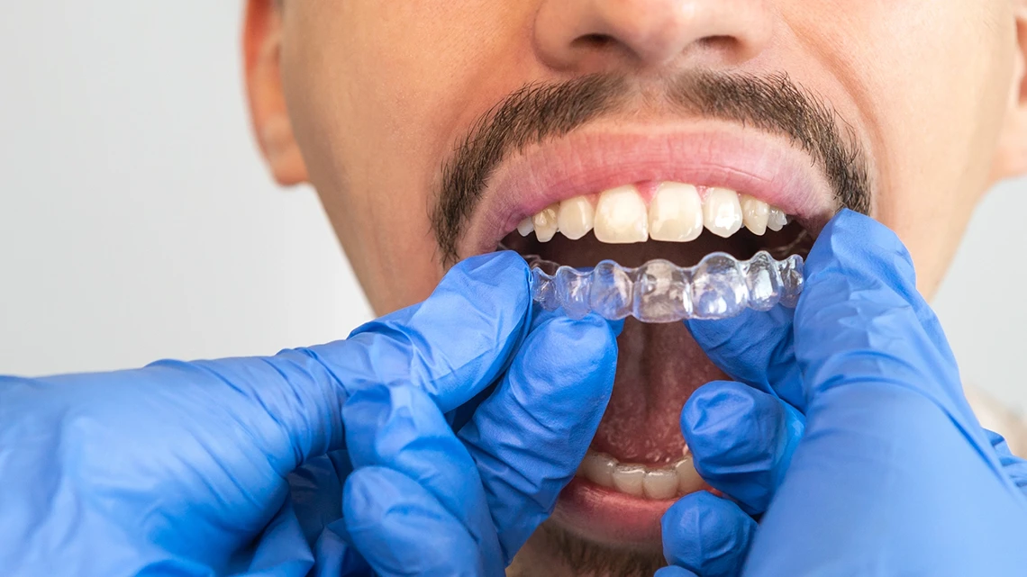 Invisible Braces Treatment 1 Invisible Braces Treatment