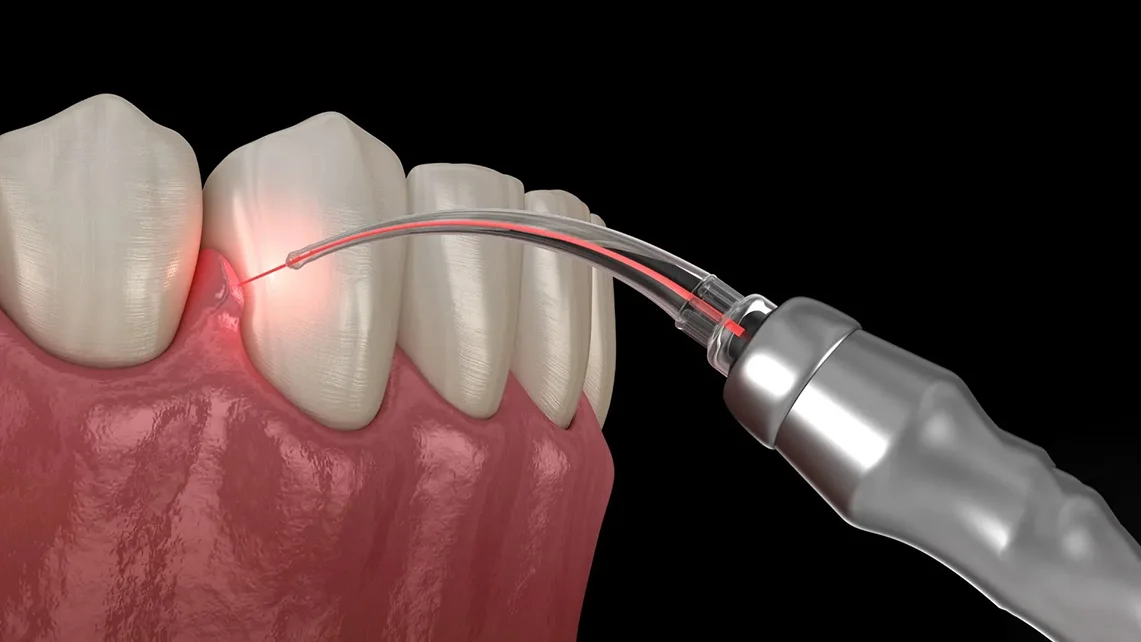 Gum Countouring 1 Gum Countouring