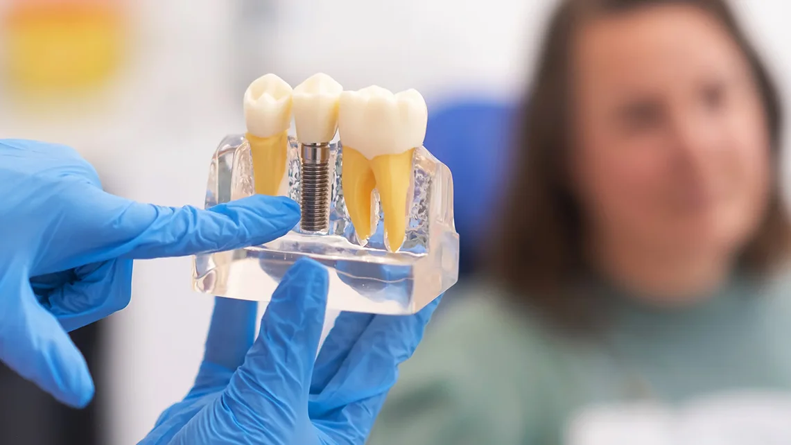 Restauración de implantes 1 Restauración de implantes