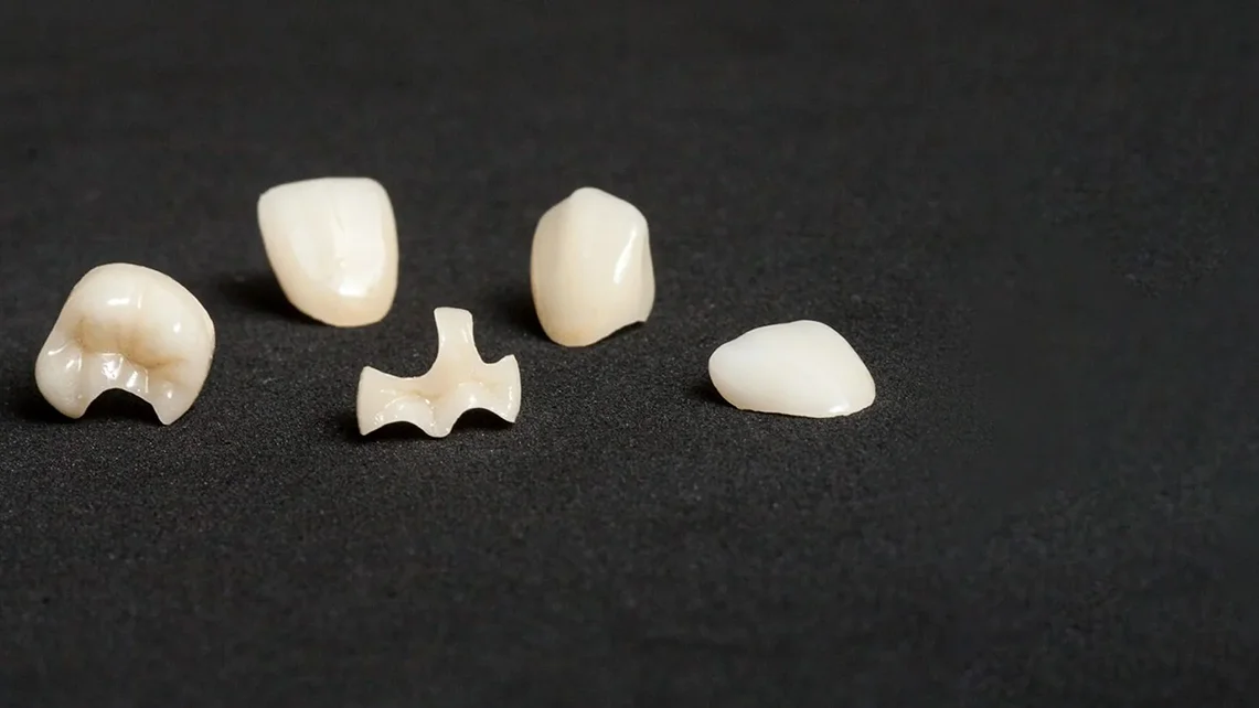 Inlay Dental Restoration 1 Inlay Dental Restoration