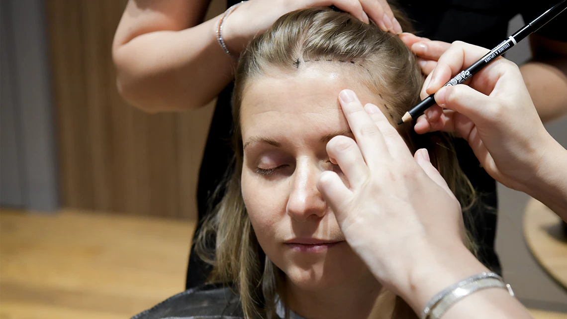 Woman Hair Transplant 1 Woman Hair Transplant