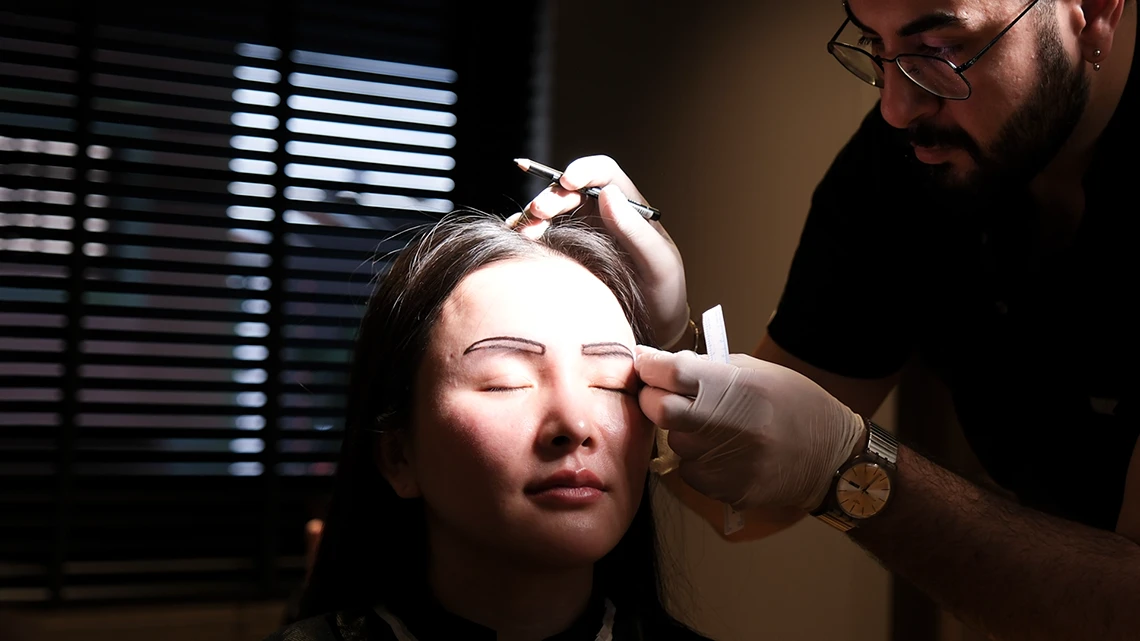 Eyebrow Transplant 1 eyebrow transplant in Turkey