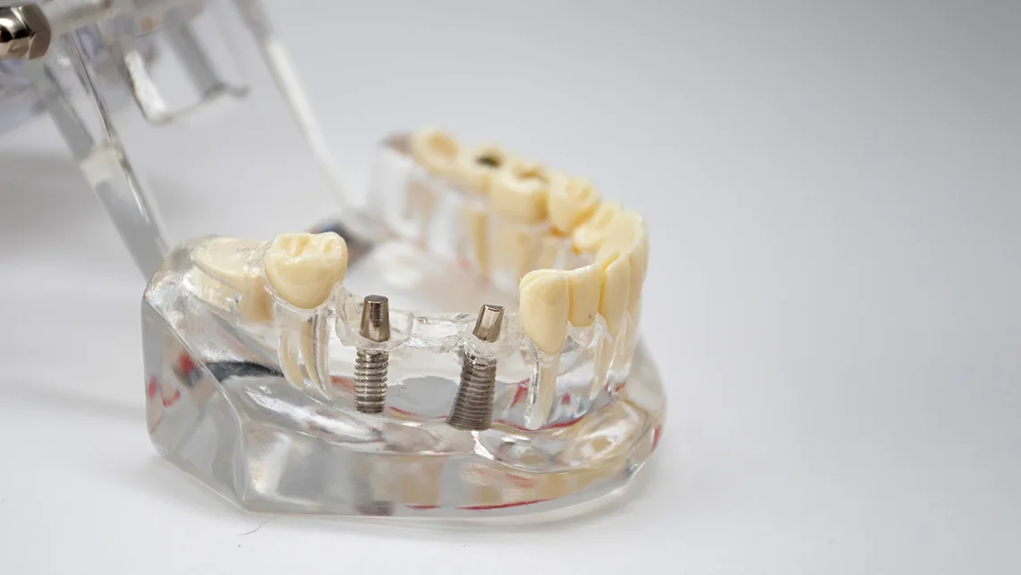 Multiple Tooth Implant