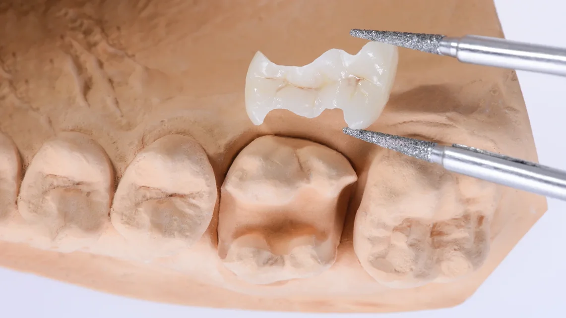 Onlay Dental Restoration 1 Onlay Dental Restoration