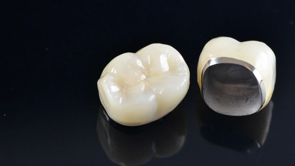 Porcelain-fused Metal Crowns 1 Porcelain-fused Metal Crowns