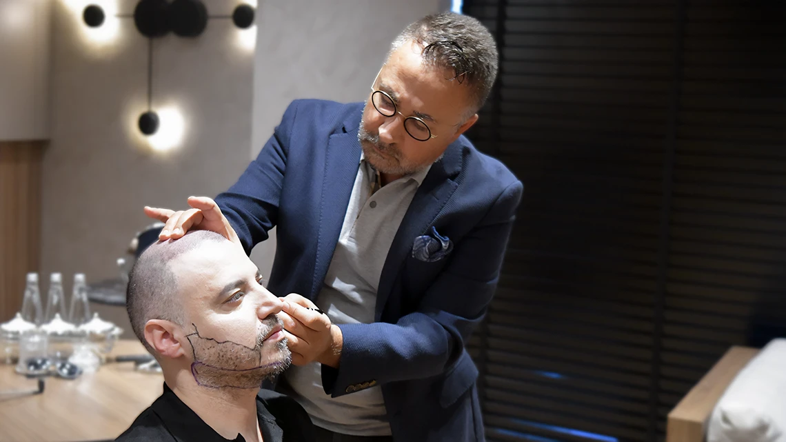 Beard, Mustache and Sideburn transplant 1 Beard, Mustache and Sideburn transplant