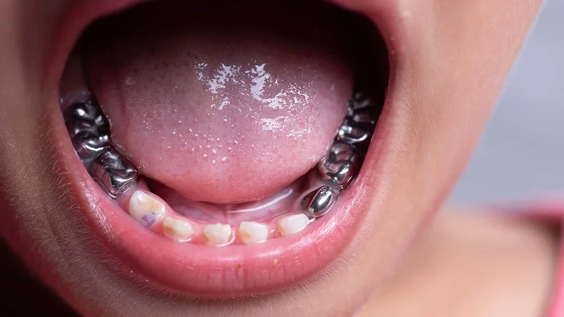 Stainless-steel Crowns 1 Stainless-steel Crowns