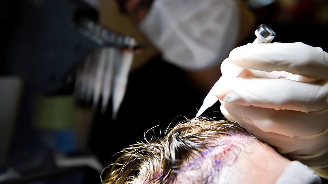 Unshaven Hair Transplant 1 Unshaven Hair Transplant