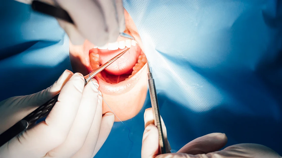 Wisdom Teeth 1 Wisdom Teeth