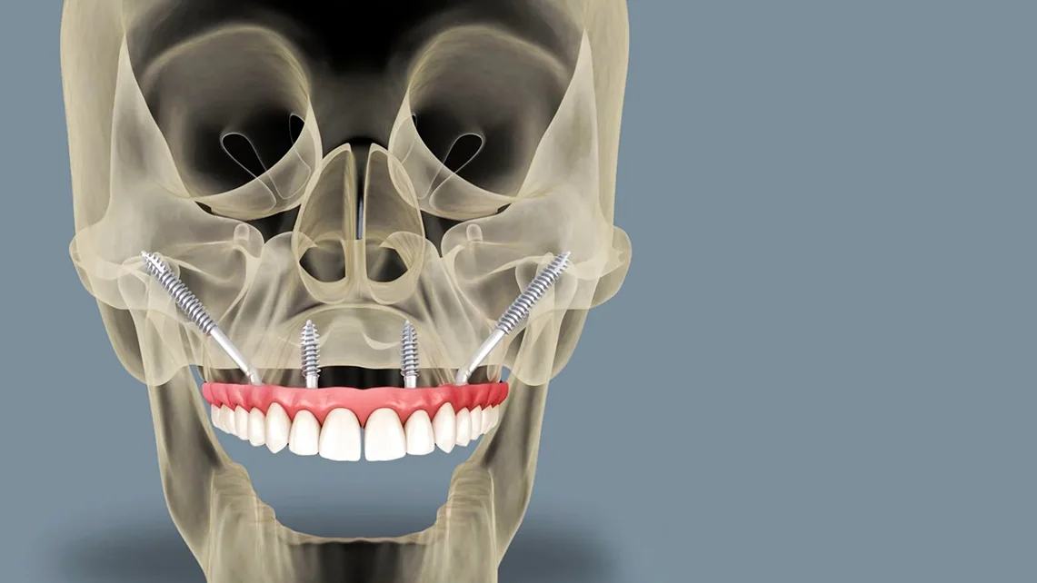 All On Four Implant 1 All On Four Implant
